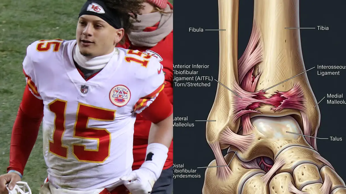 Patrick Mahomes' High Ankle Sprain: Syndesmosis Instability and Elite Sports Rehab