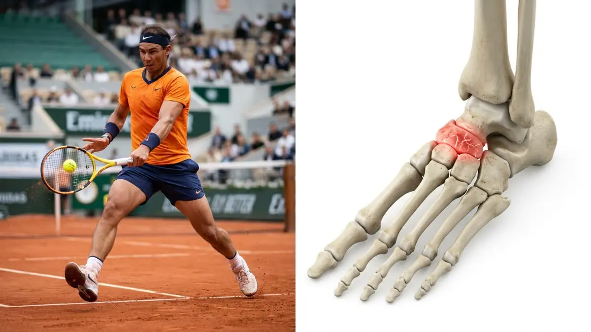 Rafael Nadal's Mueller-Weiss Foot Crisis: Biomechanical Deconstruction of Navicular Osteonecrosis and Rehabilitation