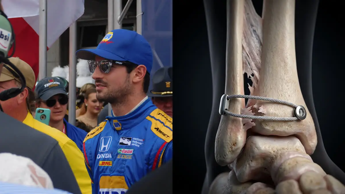 Alexander Rossi's Indy 500 Crash: Ankle Syndesmosis Biomechanics and the 6-Day Return Reality