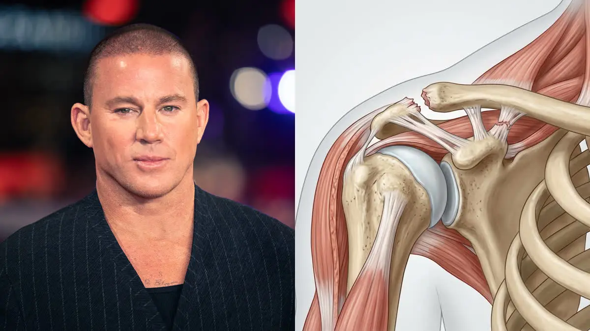 Channing Tatum undergoes surgery to repair a separated shoulder—here is why a separation is completely different from a dislocation
