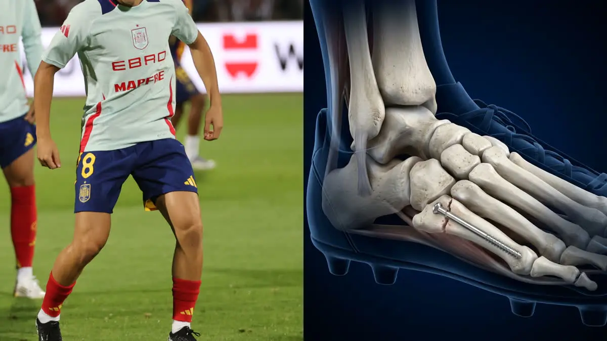 Fermín López Rules Out of World Cup: Biomechanical Reconstruction of the 5th Metatarsal Fracture