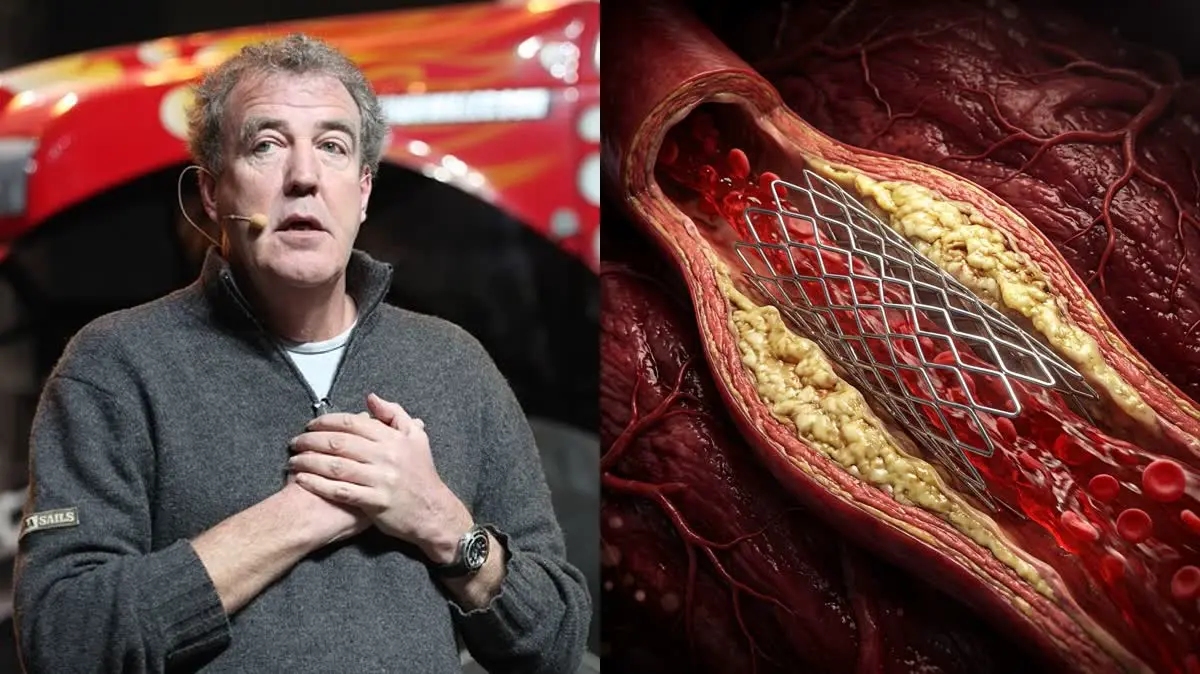 Jeremy Clarkson's Heart Stent: Coronary Artery Disease and the Ayurvedic Hridaya Protocol