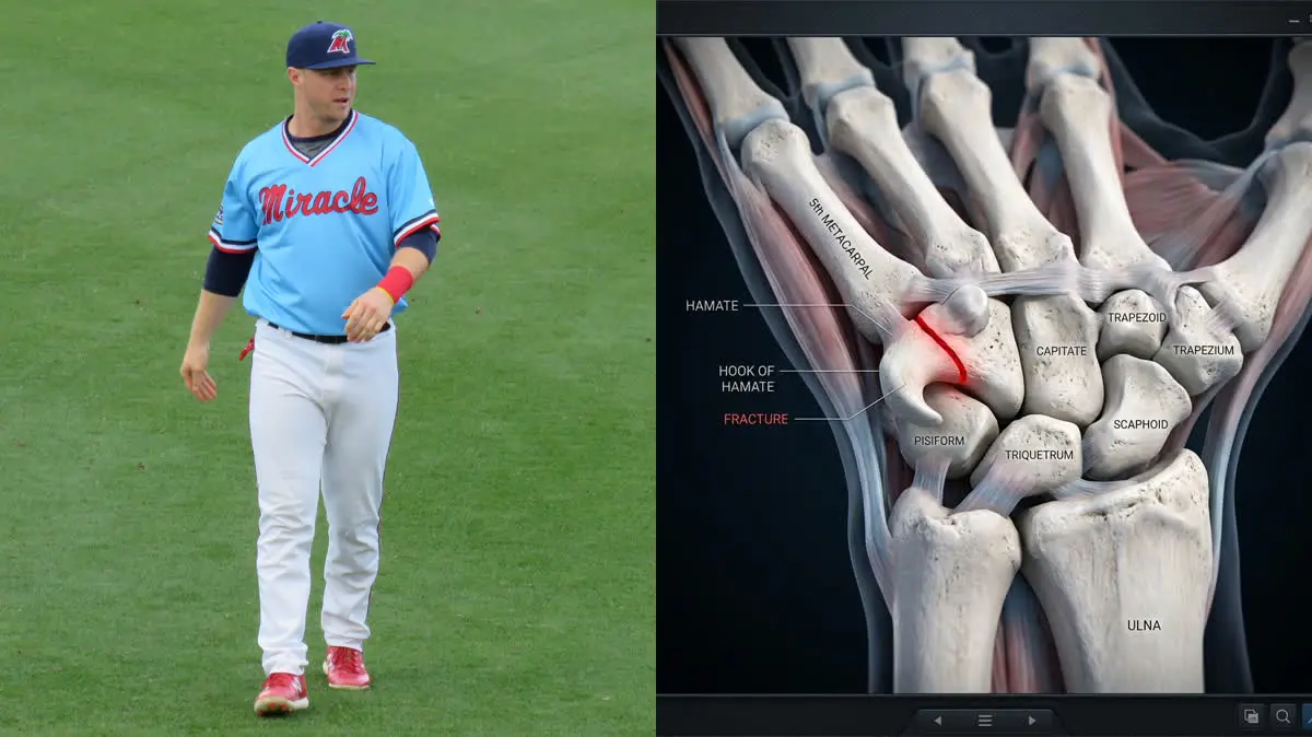 Ryan Jeffers' Hamate Fracture: Wrist Grip Biomechanics, Hook Excision, and Catcher Rehabilitation